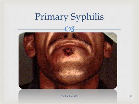 Ppt Syphilis Powerpoint Presentation Free Download Id123585