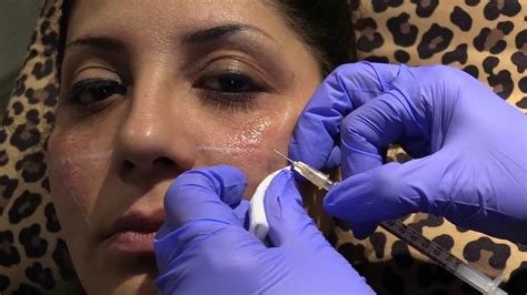 Tear Trough Correction With Filler And Prp Youtube