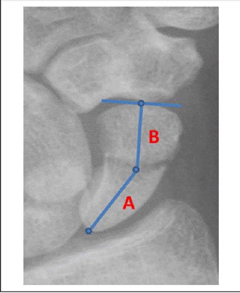 Figure 1 From Comparison Of Fracture Location And Extent Of Comminution In Isolated Scaphoid