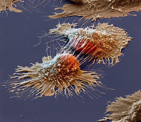 Der Blog!: This is what cancer cells look like under an electron microscope