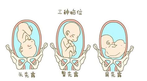 胎位（来源：知乎）医学影像mr新浪博客