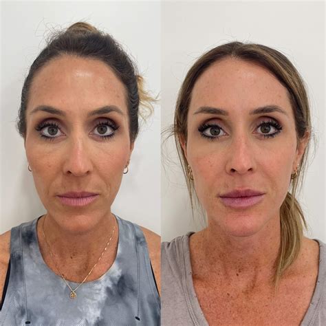 Sculptra Before After Images Medspa In Newport Beach CA