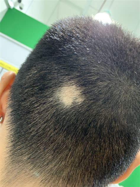 Bald Spot At The Back Of My Head Any Idea What Could Cause This R Malehairadvice