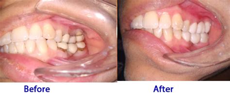 Root Canal Crown Before And After