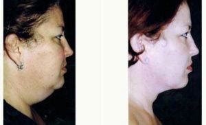 Cost Of Facelift In Miami Facelift Info Prices Photos Reviews Q A