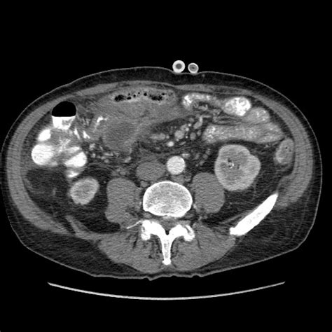 File Journey Through Necrotizing Pancreatitis Presentation Walled Off Necrosis Complicated By