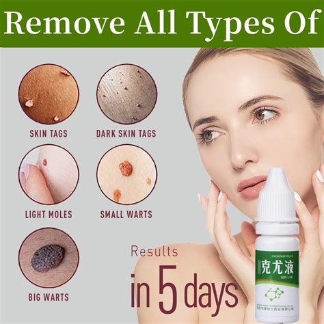 Ml Warts Remover Liquid Remove Foot Corns Mole Skin Tags Get Rid Of