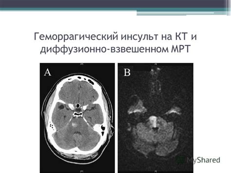Презентация на тему: "Тяжелый ишемический и геморрагический инсульт ...