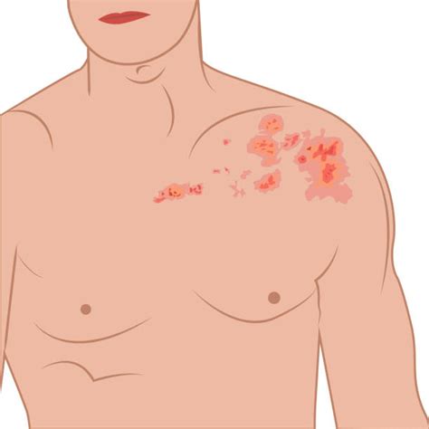 Mais De 1100 Ilustrações De Stock Gráficos Vetoriais E Clipart Royalty Free Sobre Herpes