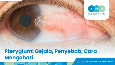 Penyakit Pterygium Gejala Penyebab Cara Mengobati