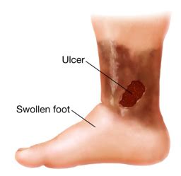 Integ Wk 2 Vascular Ulcers Flashcards Quizlet