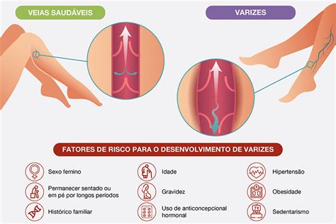 Varizes O Que S O Principais Causas E Como Tratar