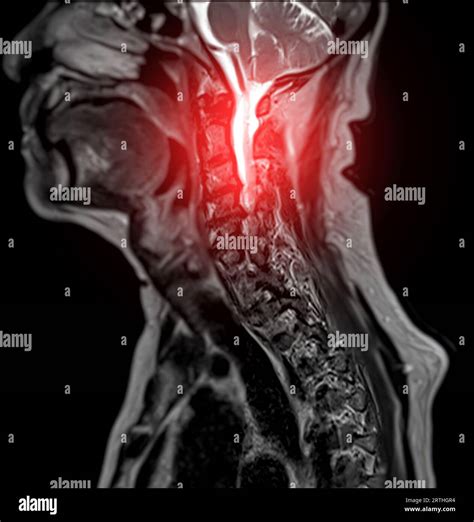 Irm Du Rachis Cervical Ou Imagerie Par R Sonance Magn Tique De La Vue