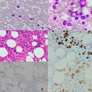 Peripheral Blood Smear A And Bone Marrow Aspirate B Showing Small