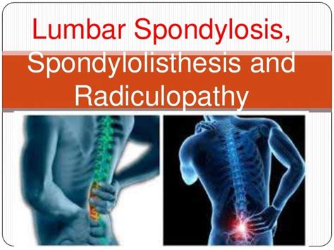 Lumbar Spondylosis X Ray