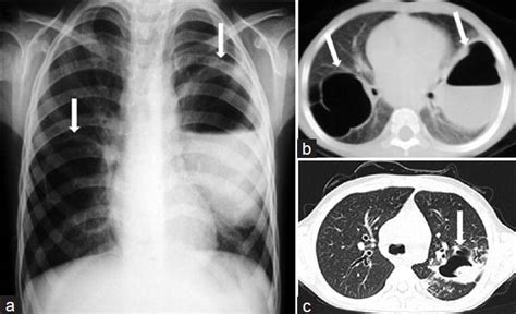 Cystic And Cavitary Lung Lesions In Children Radiologic Findings With