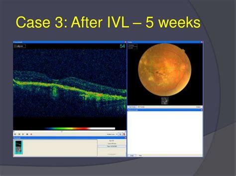 How 3 d oct enhances amd & dme treatment