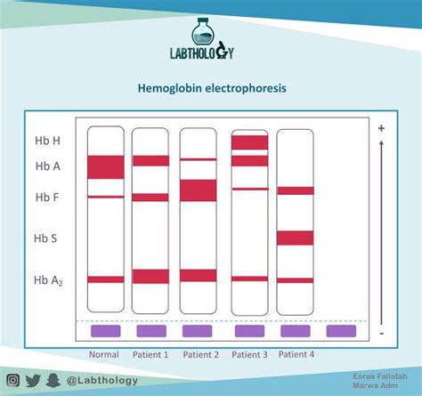 Hemoglobin Electrophoresis MEDizzy