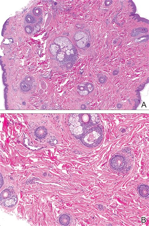 Temporal Triangular Alopecia Acquired In Adulthood Mdedge Dermatology