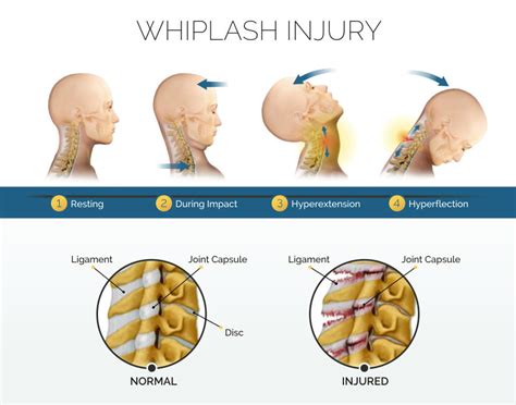 Whiplash Neck Pain Painless Chiropractic And Neuropathy Treatment Center