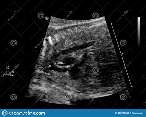 Ultrasound Scherm Met Foetale Echocardiografie Stock Afbeelding Image