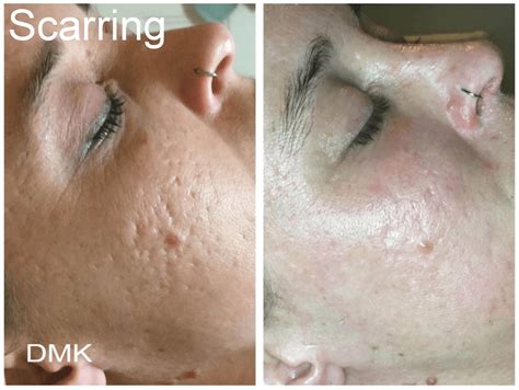 Skin Peel Treatments Skinrx Aesthetic Clinic Pty Ltd