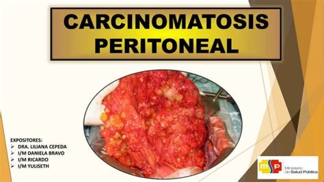 Carcinomatosis Peritoneal PPT