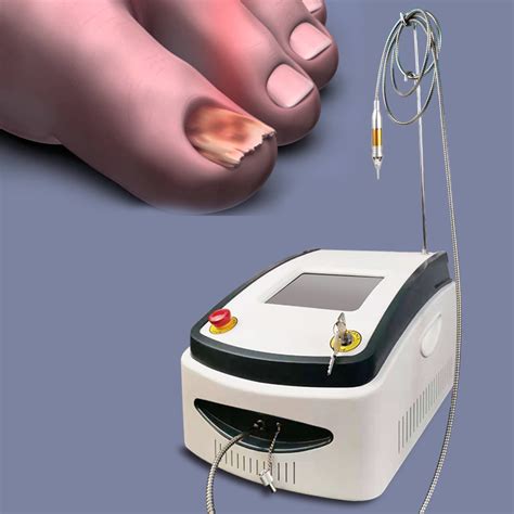 60 Watt Laser Nail Fungus Laser Machine 980 Nm Nail Fungus Device Toe