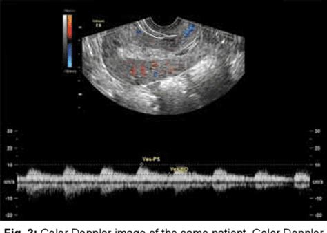 Ultrasound Imaging of Postpartum Hemorrhage | Semantic Scholar