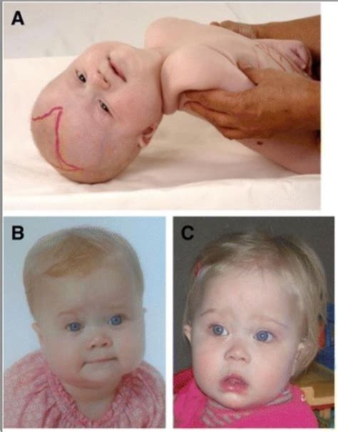 Zellweger Syndrome Peroxisomes