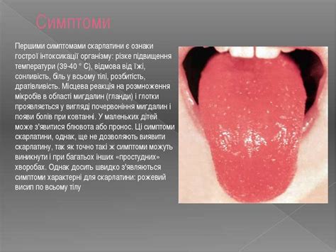 Скарлатина - презентація з медицини