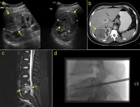 Renal Cell Carcinoma Radiology At St Vincents University Hospital