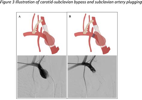 Hybrid Repair Of An Innominate Artery Pseudoaneurysm After Blunt