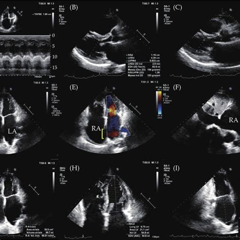 Baseline Two Dimensional Transthoracic Echocardiogram Color Doppler