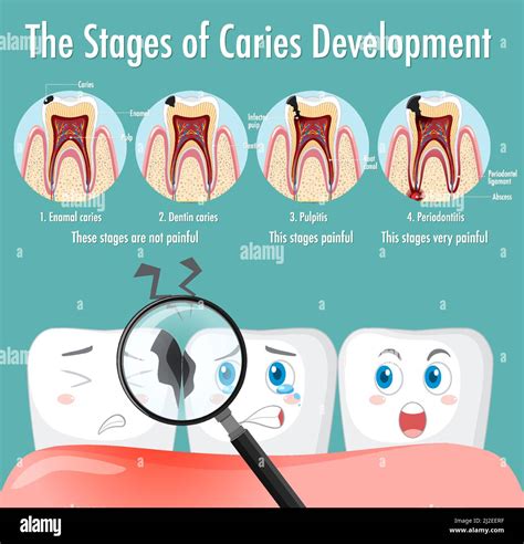 Infographic Of Human In Stages Of Caries Development Illustration Stock