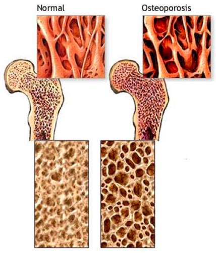 Osteoporose Karteikarten Quizlet