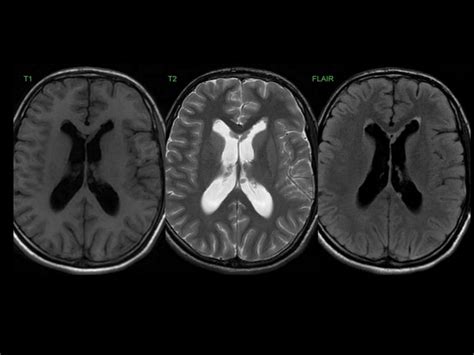 MRI basics - How to read and understand MRI sequences