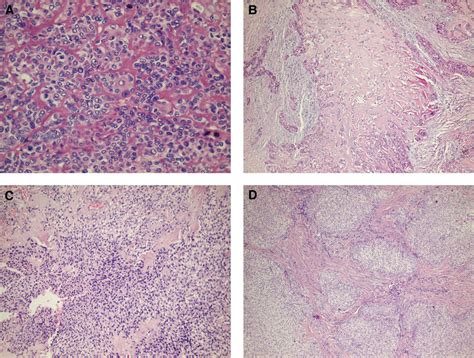 A Epithelioid Tumor Cells Forming Small Nests And Cords With