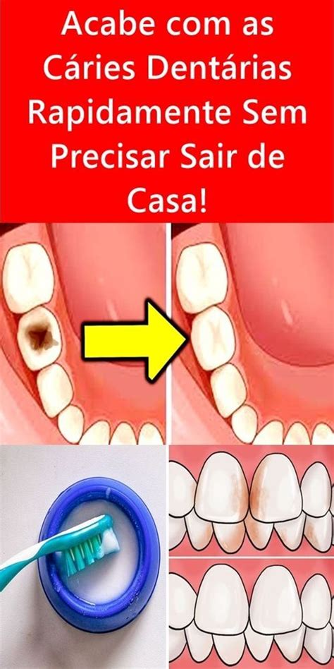 Acabe Com As Cáries Dentárias Rapidamente Sem Precisar Sair De Casa