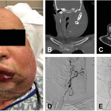 A Postoperative Day 3 Patient Started Progressive Bleeding In The