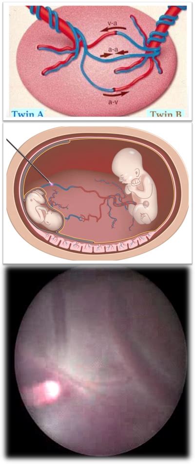 Fetal Therapy Chennai Fetal Care