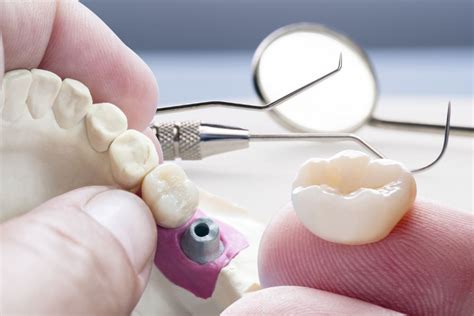 Dental Crowns Everything You Need To Know Narre Warren Dental Care