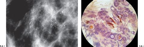 The Diagnostic Approach to Malignant Type Calcifications on the ...