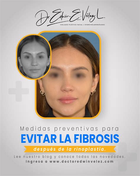 Medidas Preventivas Para Evitar La Fibrosis Despu S De La Rinoplastia