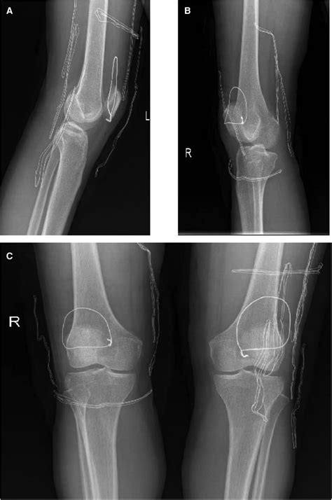 Frontiers Rebuilding Strength Surgical Intervention And