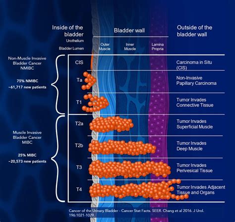 Nmibc Mibc Mechanism Of Action Of Cg Cg Oncology