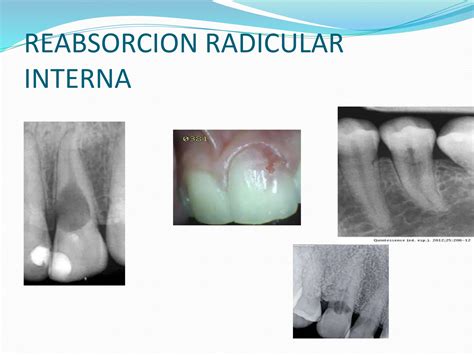 Diagnostico Pulpar Y Periapical Endo Pptx