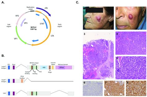 Merkel Cell Polyomavirus Mcpyv And Merkel Cell Carcinoma Mcc A