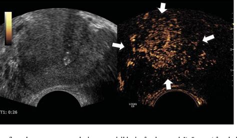 Figure 1 From Percutaneous Irreversible Electroporation Ire Of