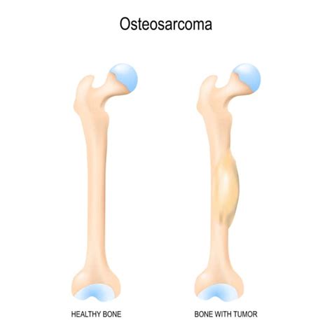 Patofisiologi Osteosarcoma